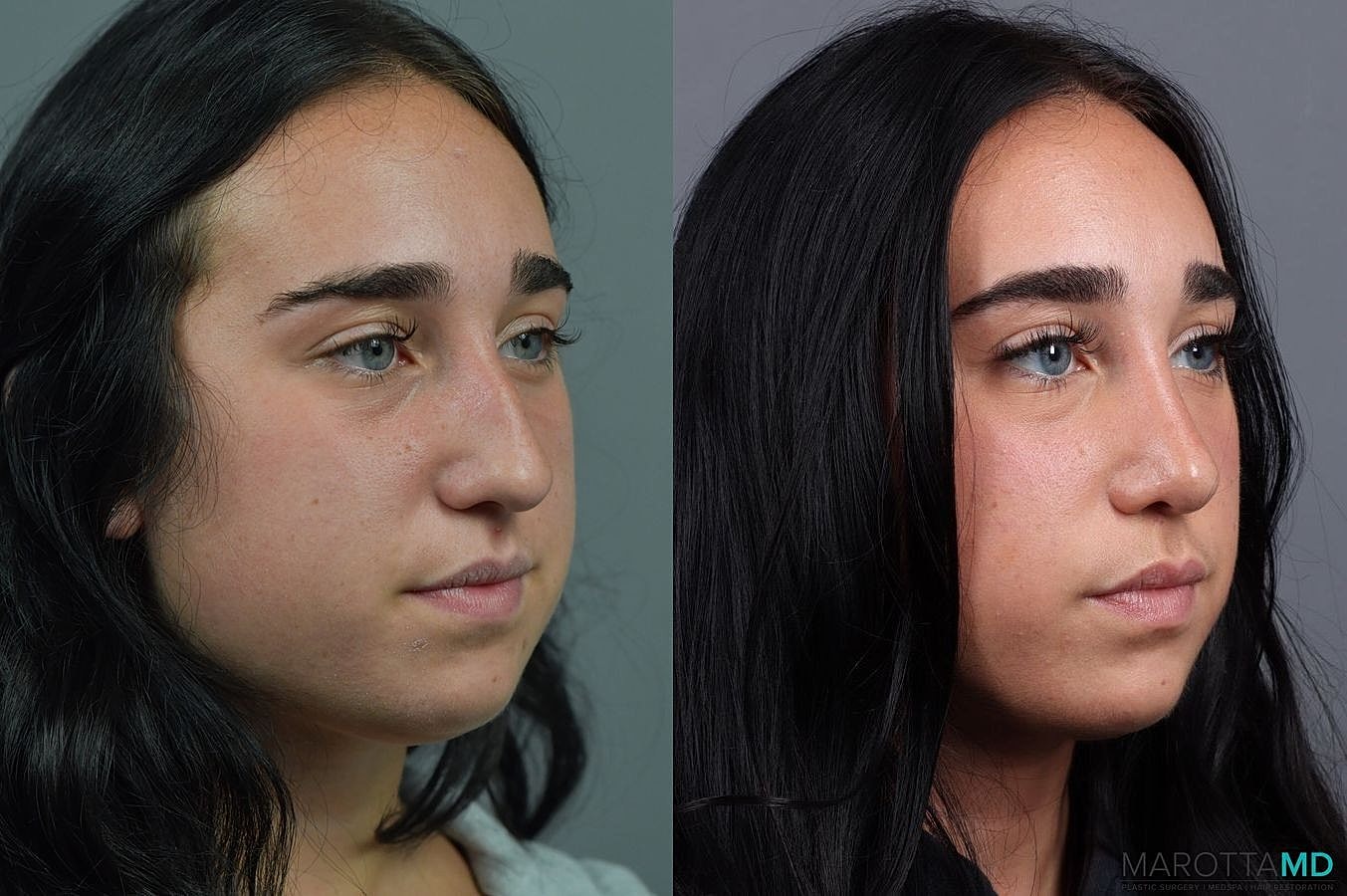 Nose Surgery Before & After