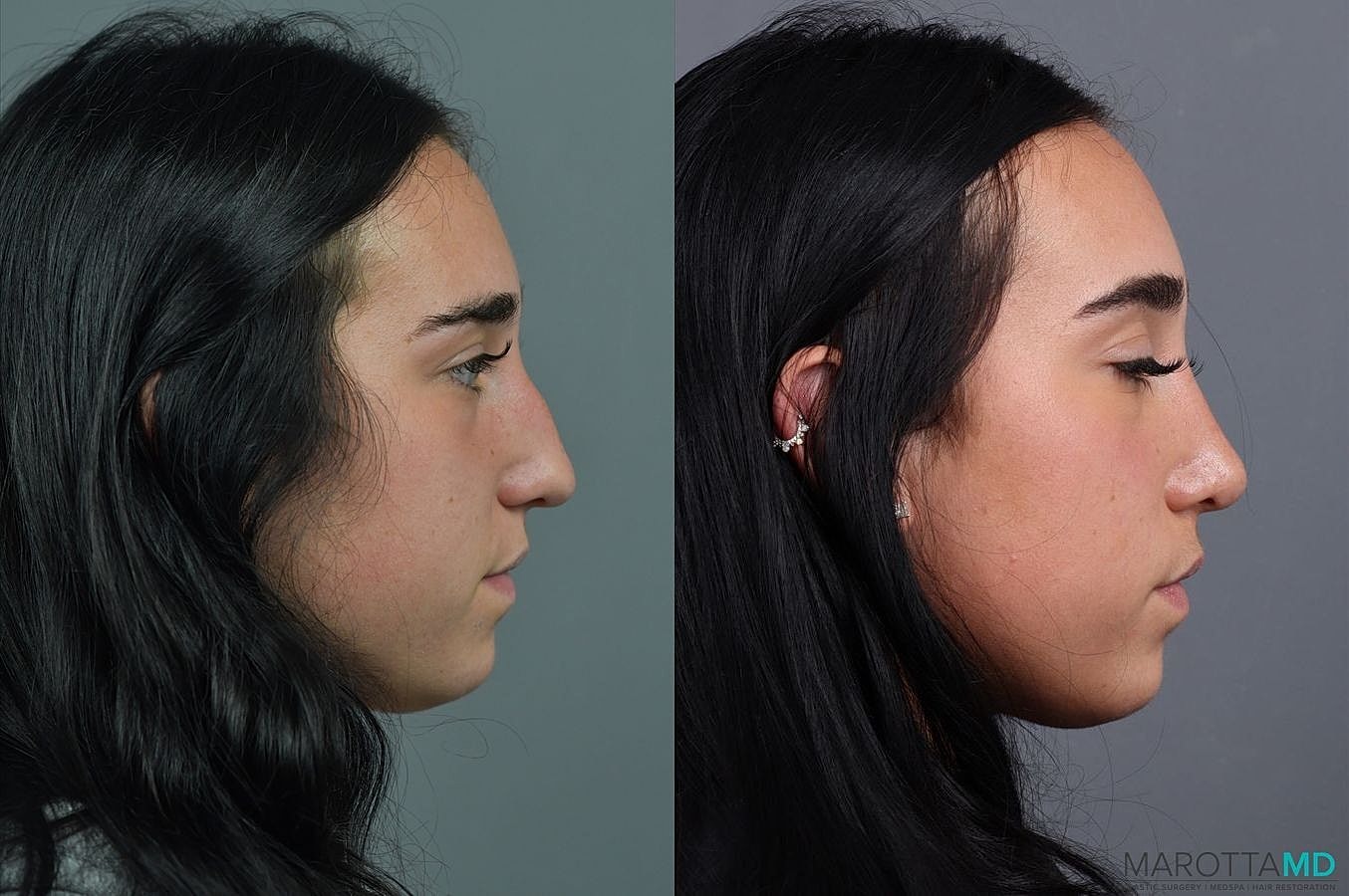 Nose Surgery Before & After