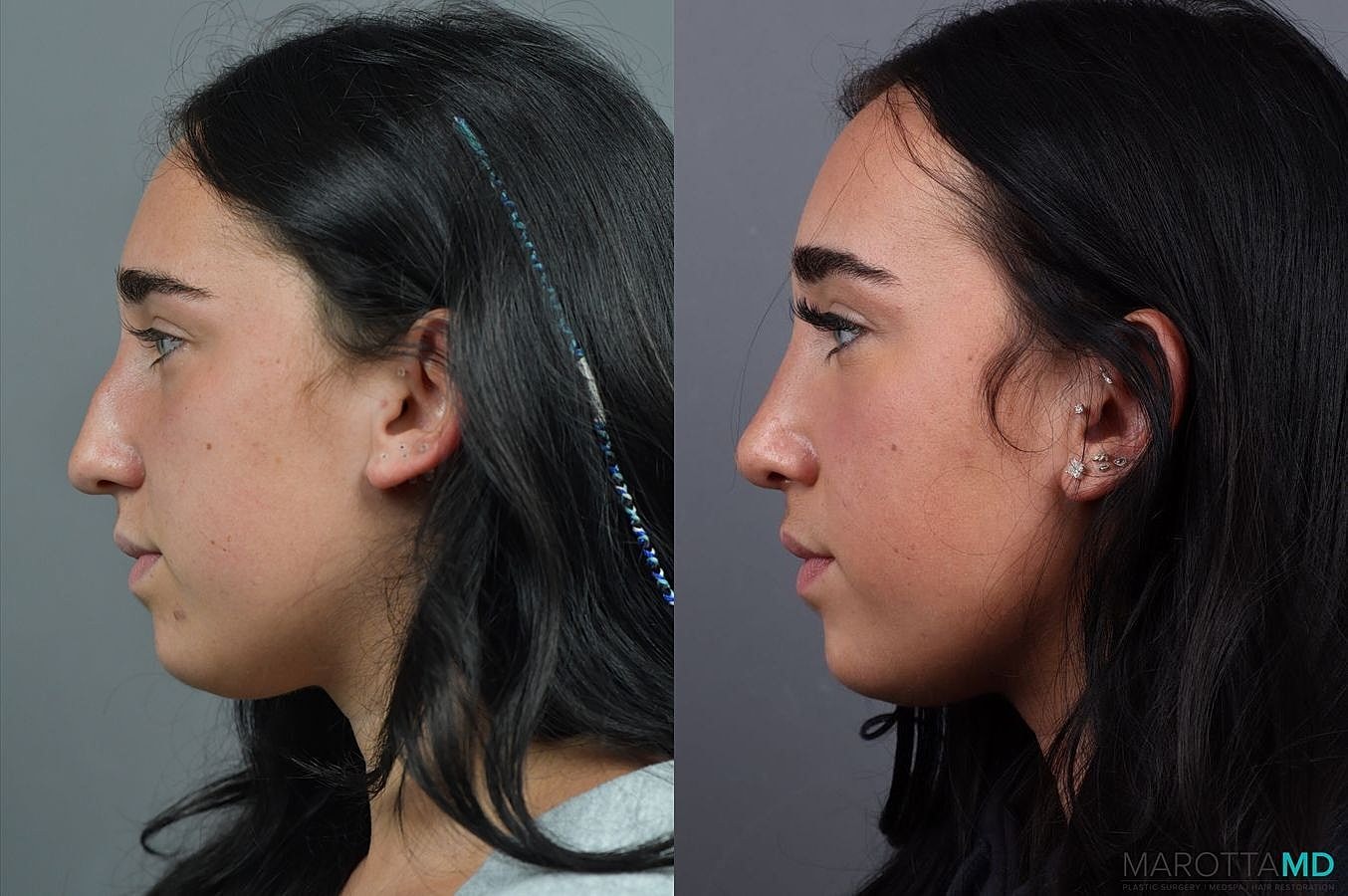 Nose Surgery Before & After