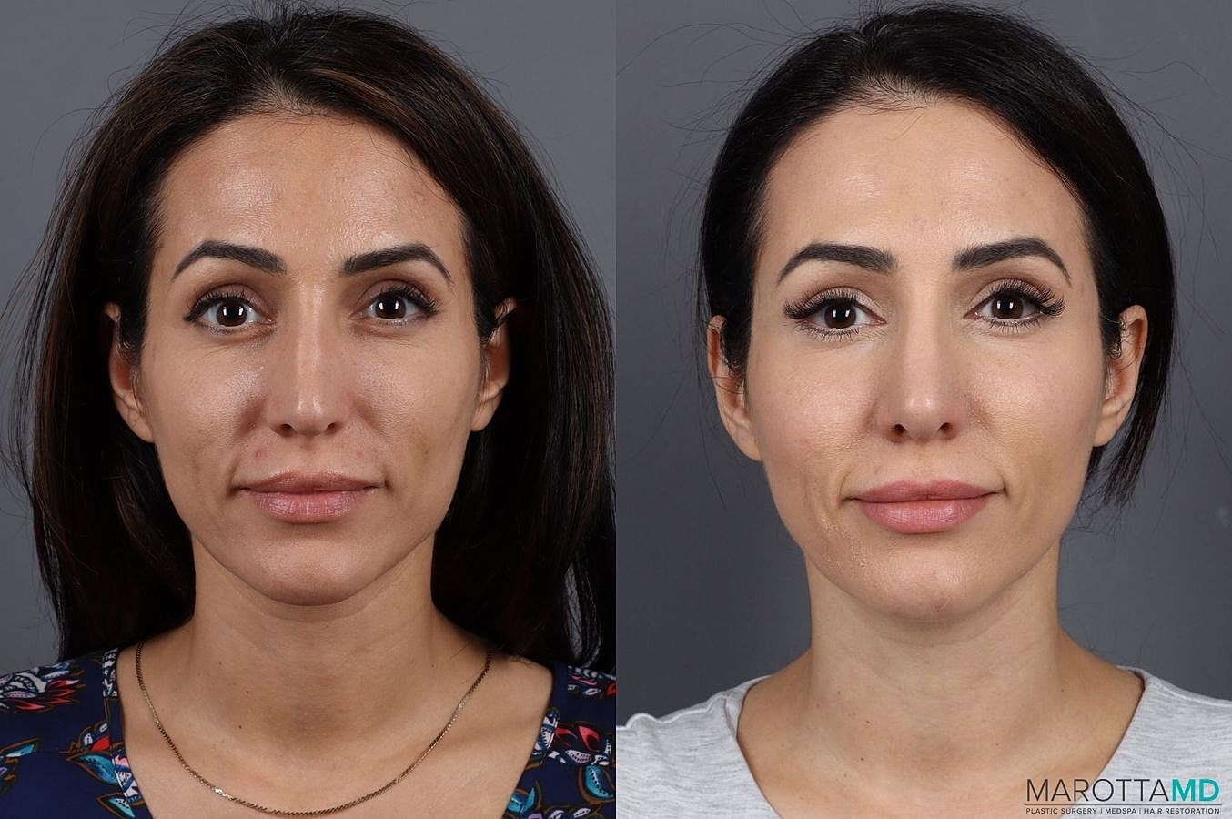Nose Surgery Before & After