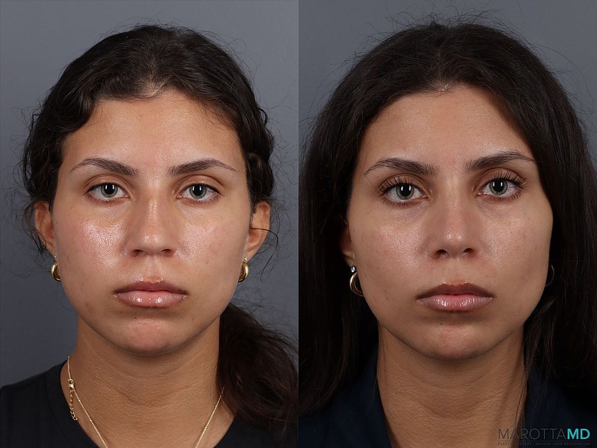 Nose Surgery Before & After