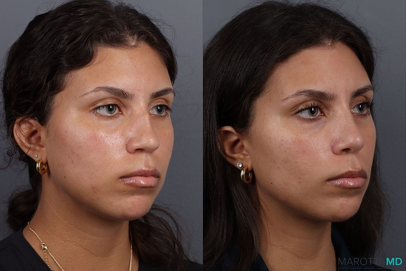 Nose Surgery Before & After