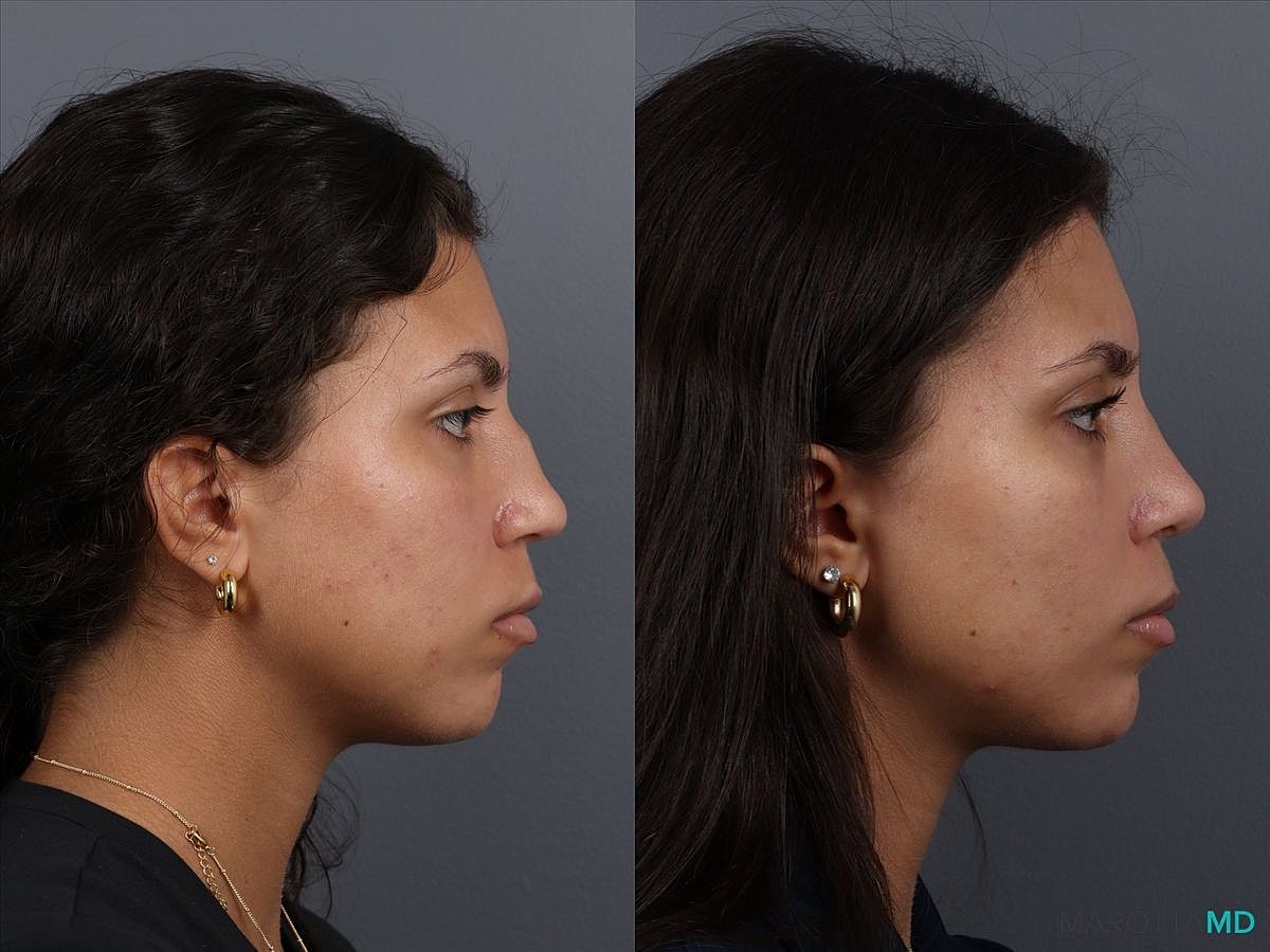 Nose Surgery Before & After