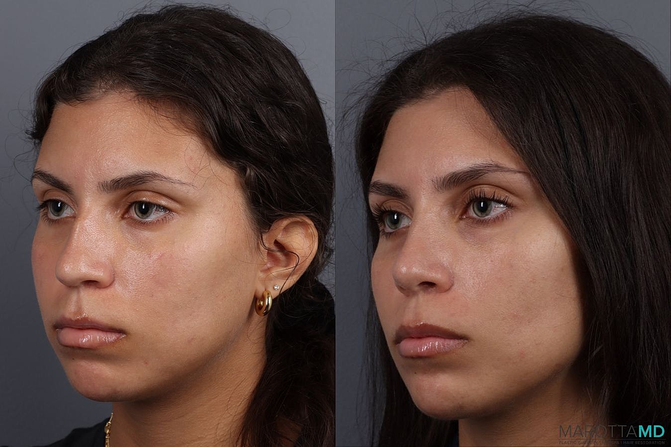 Nose Surgery Before & After