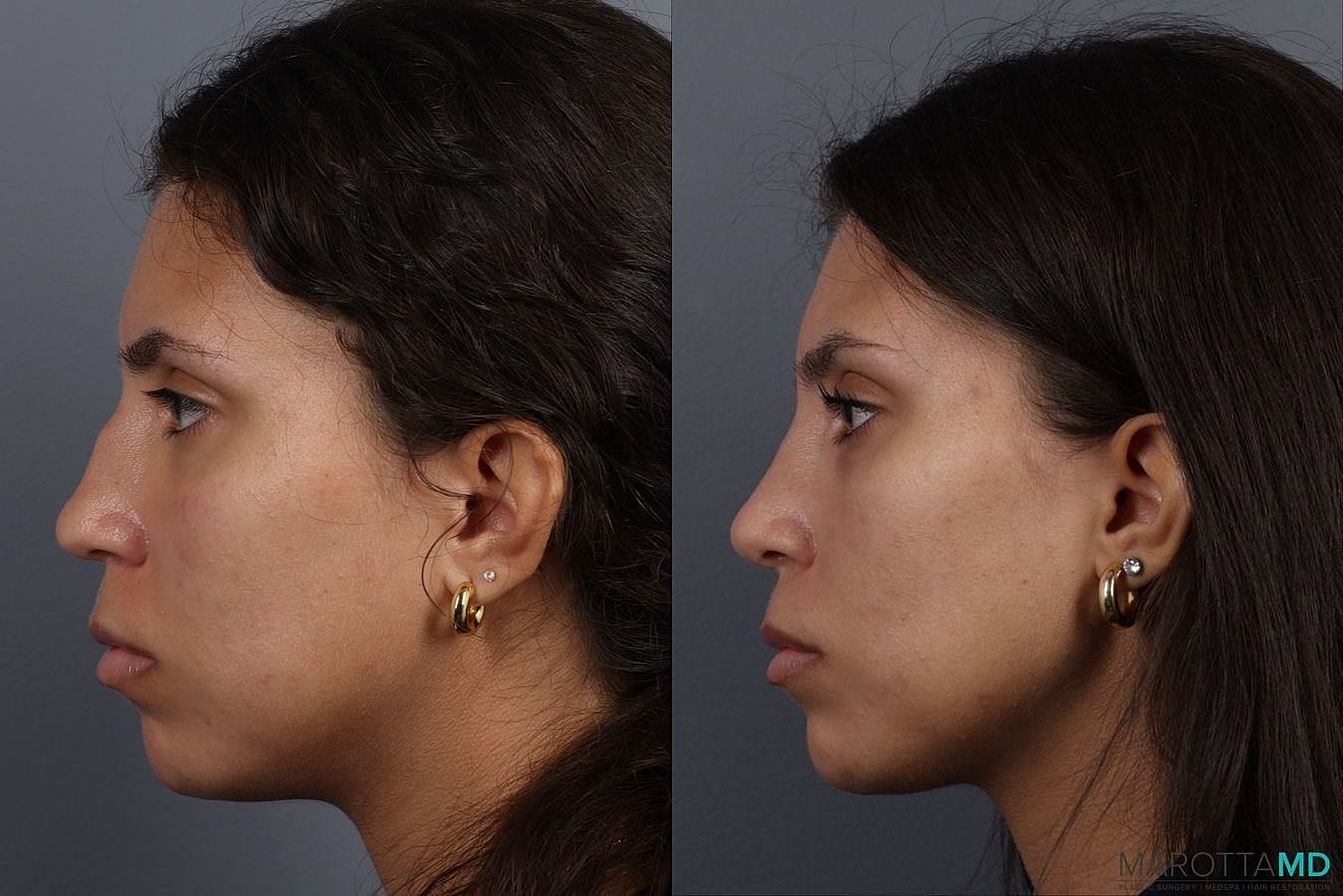 Nose Surgery Before & After