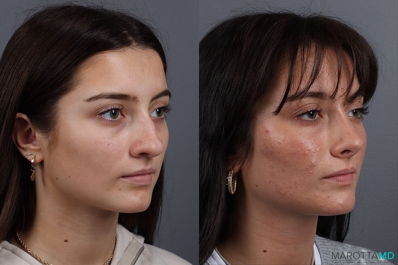 Nose Surgery Before & After