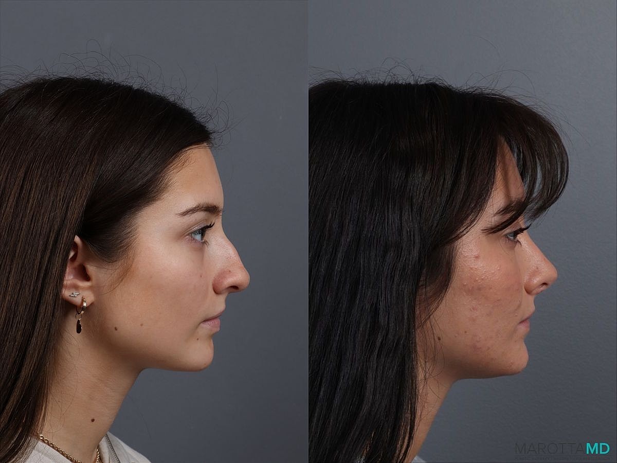 Nose Surgery Before & After