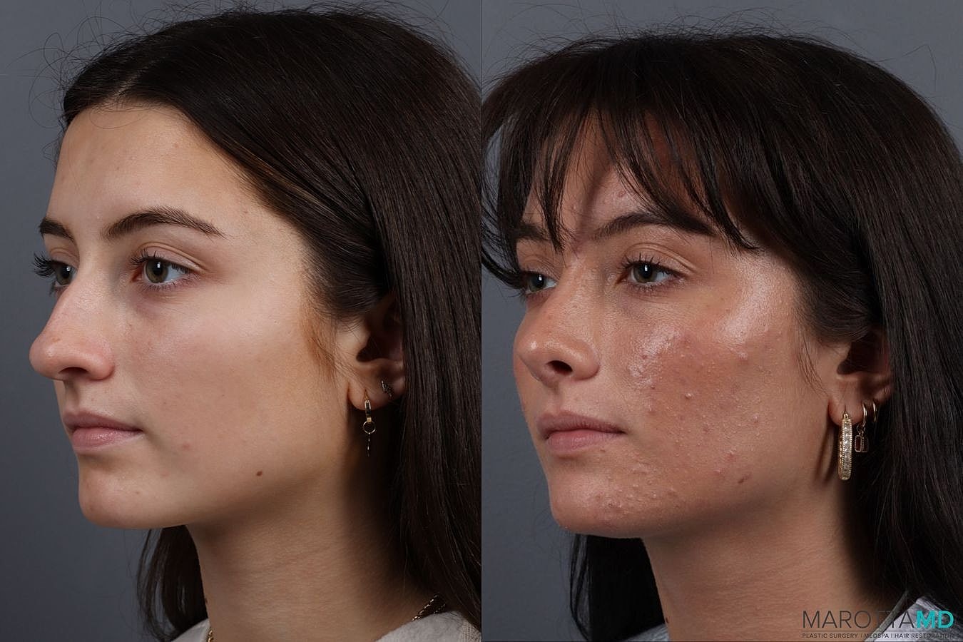 Nose Surgery Before & After