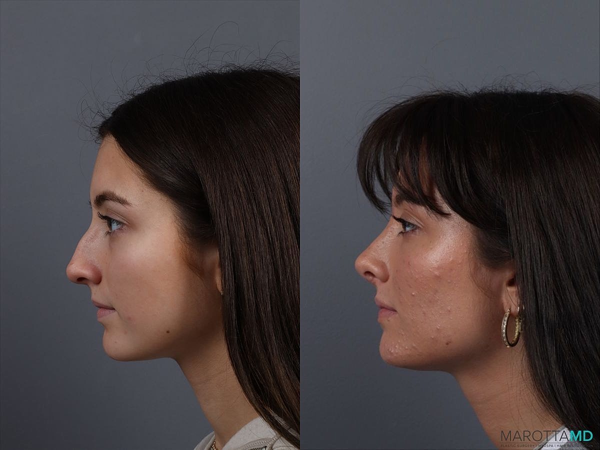 Nose Surgery Before & After