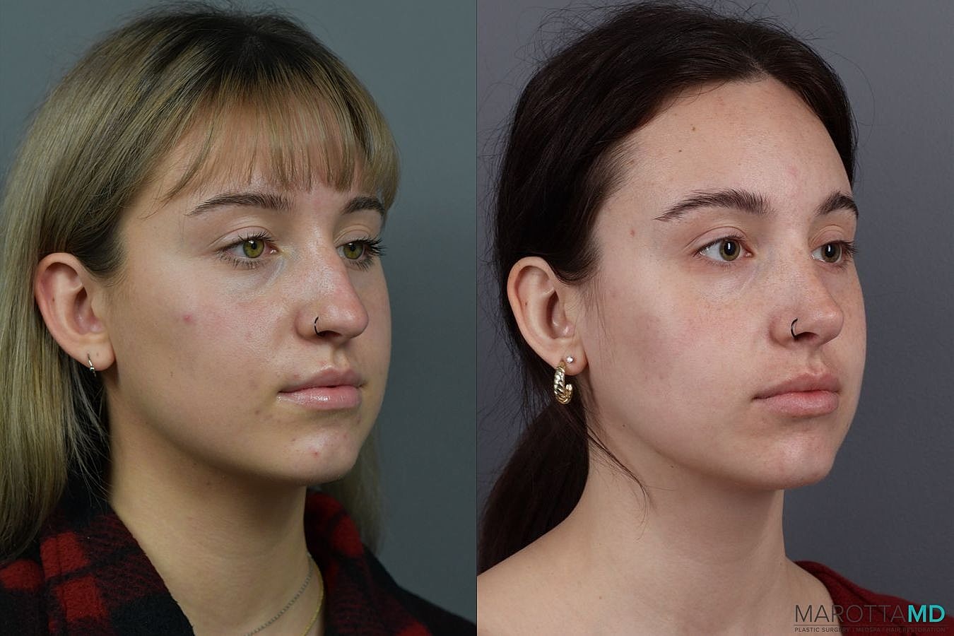 Nose Surgery Before & After