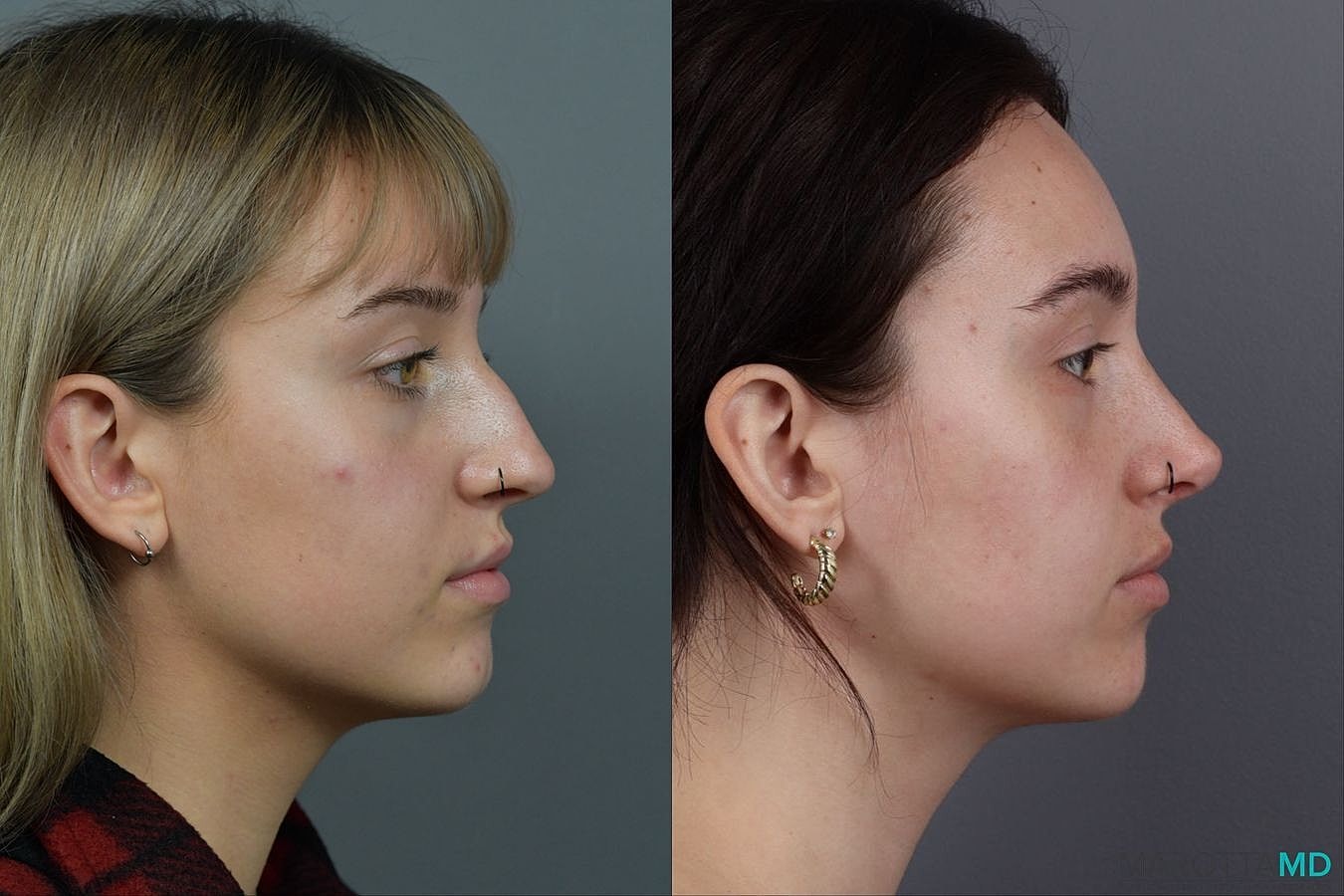 Nose Surgery Before & After