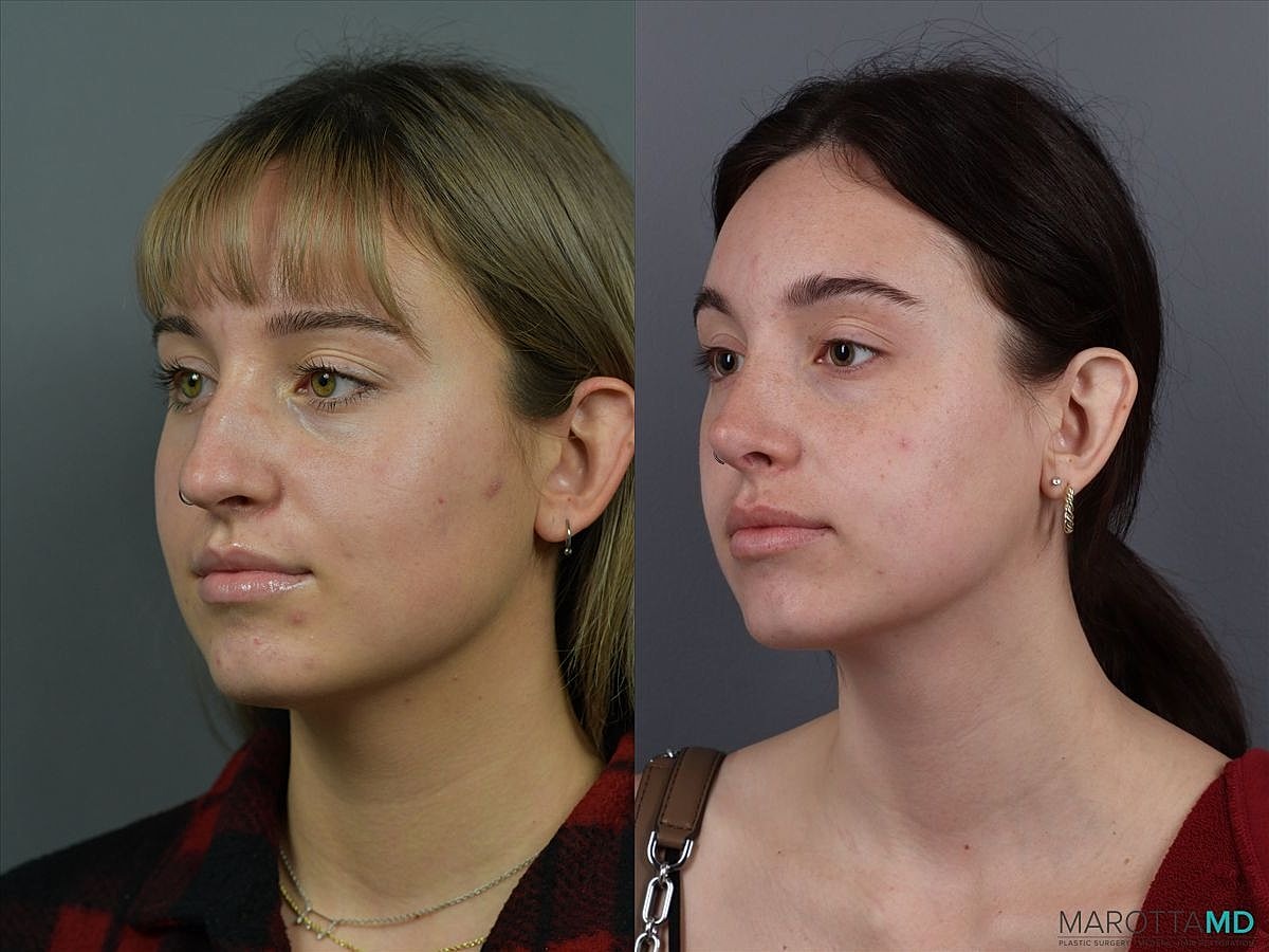 Nose Surgery Before & After