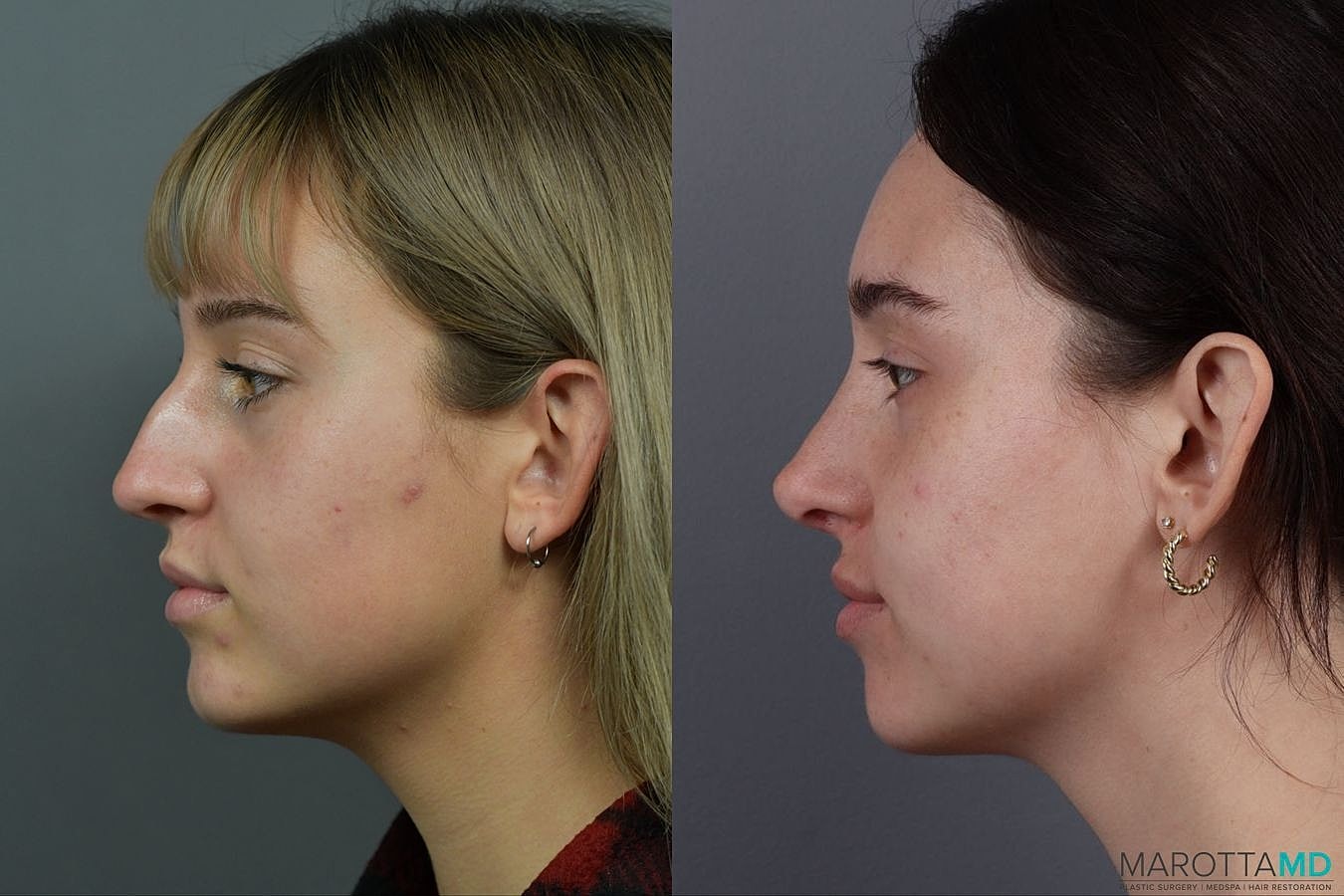 Nose Surgery Before & After