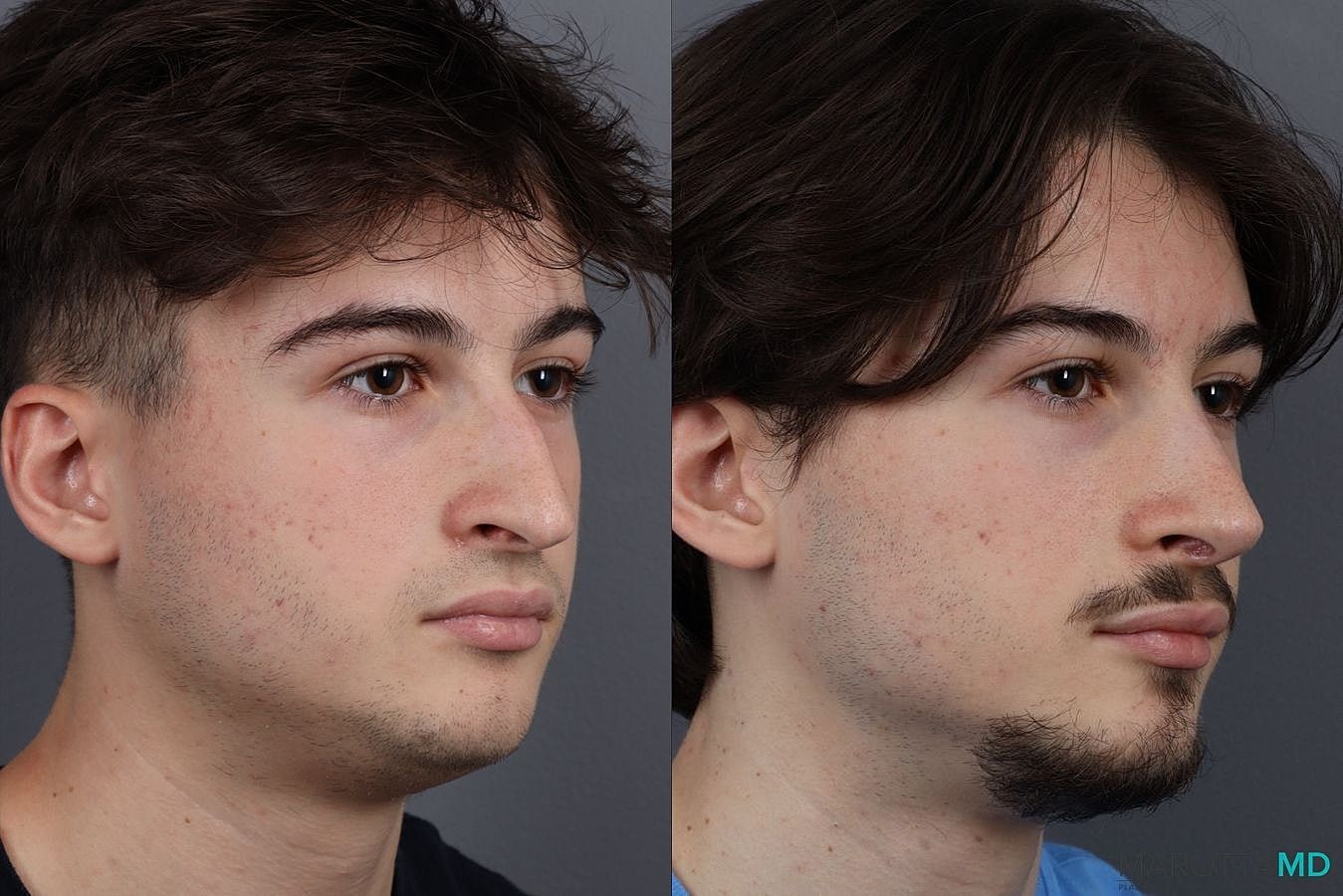 Nose Surgery Before & After