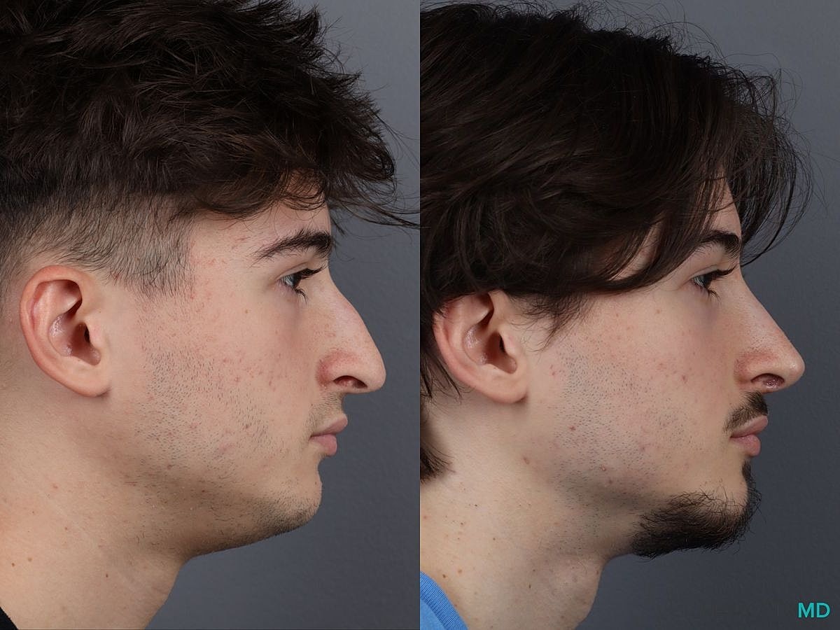 Nose Surgery Before & After