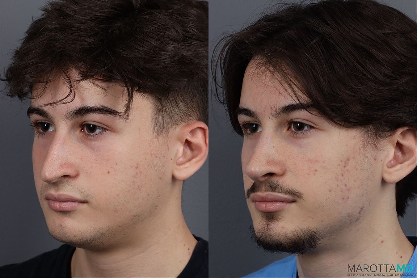 Nose Surgery Before & After