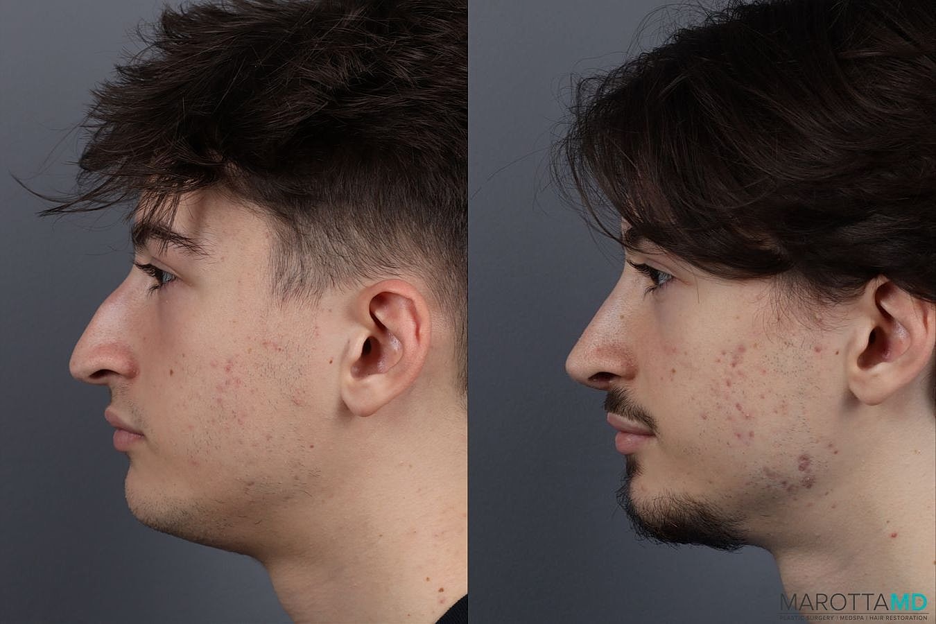 Nose Surgery Before & After