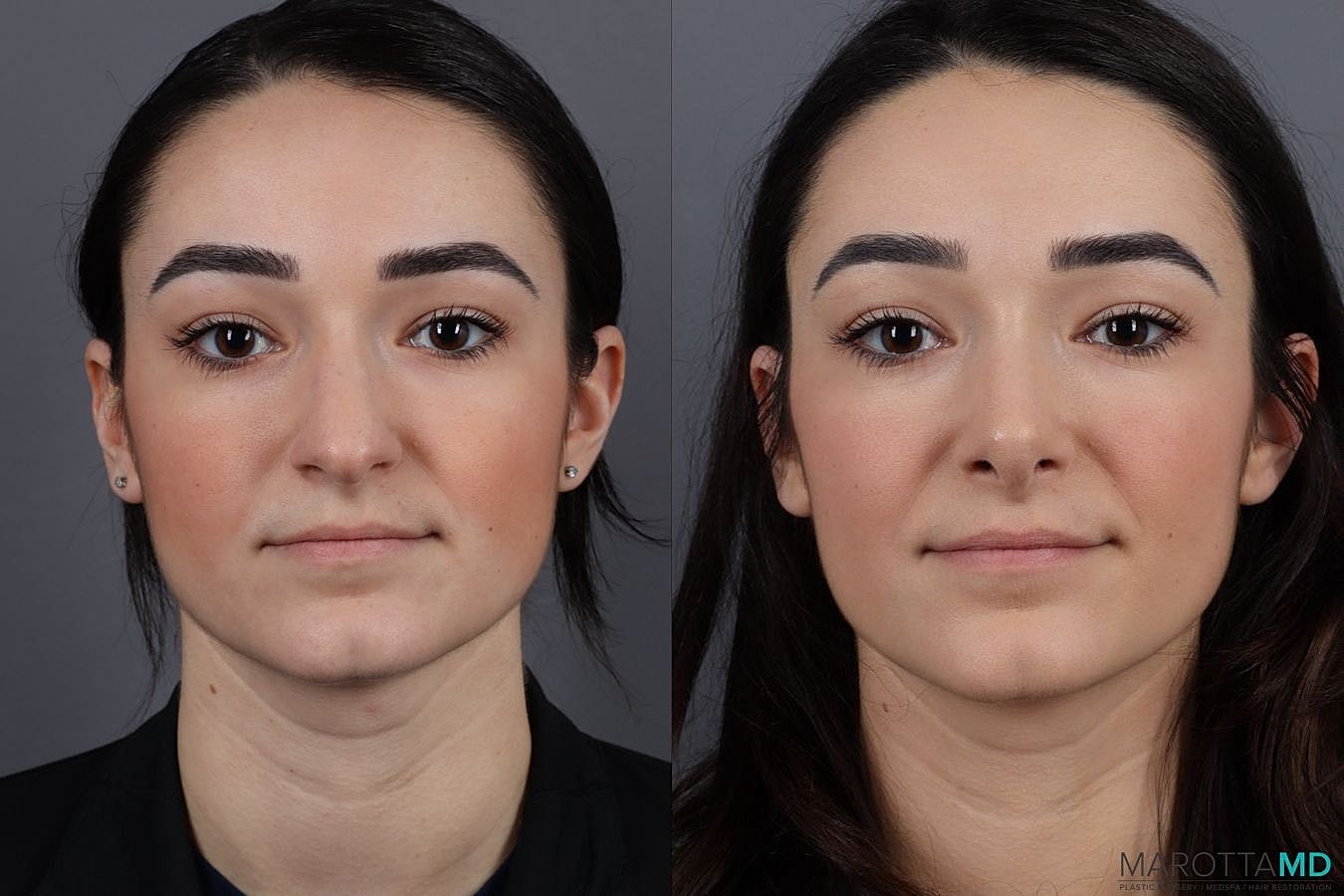 Nose Surgery Before & After