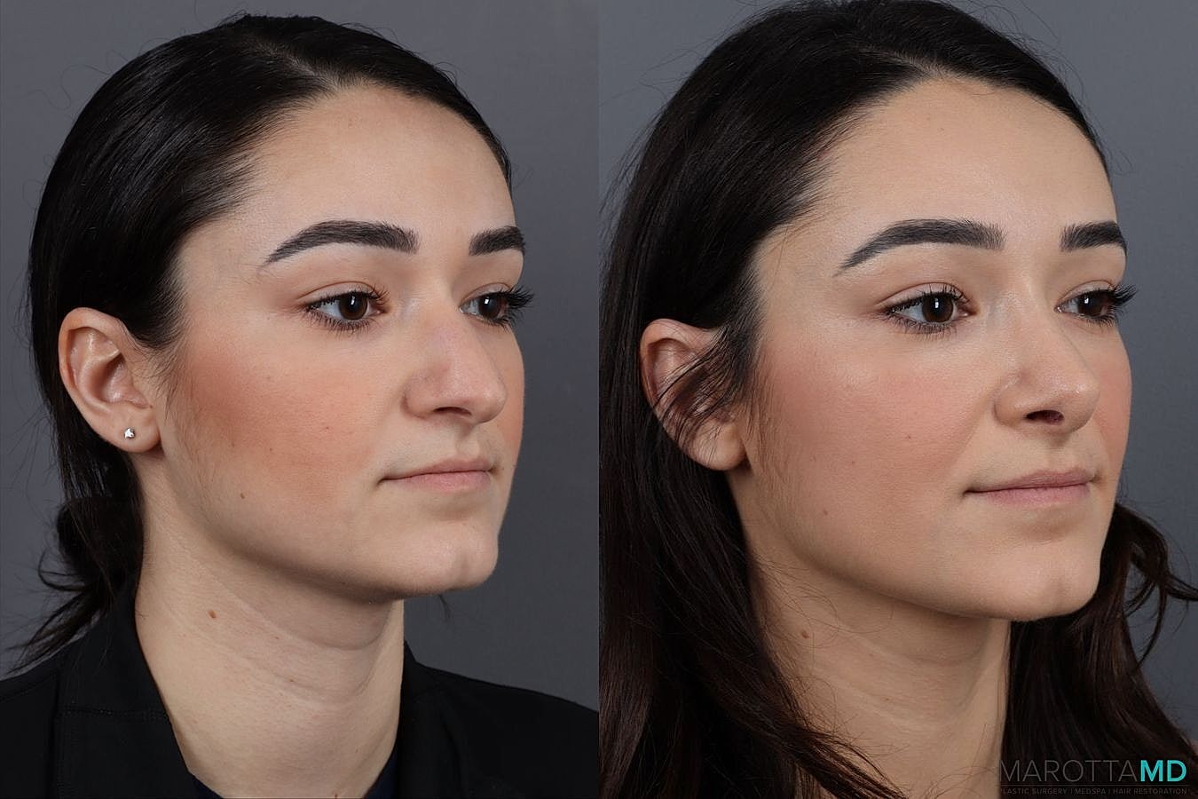 Nose Surgery Before & After