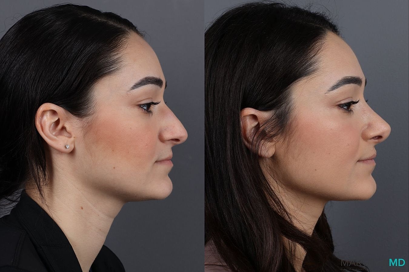 Nose Surgery Before & After