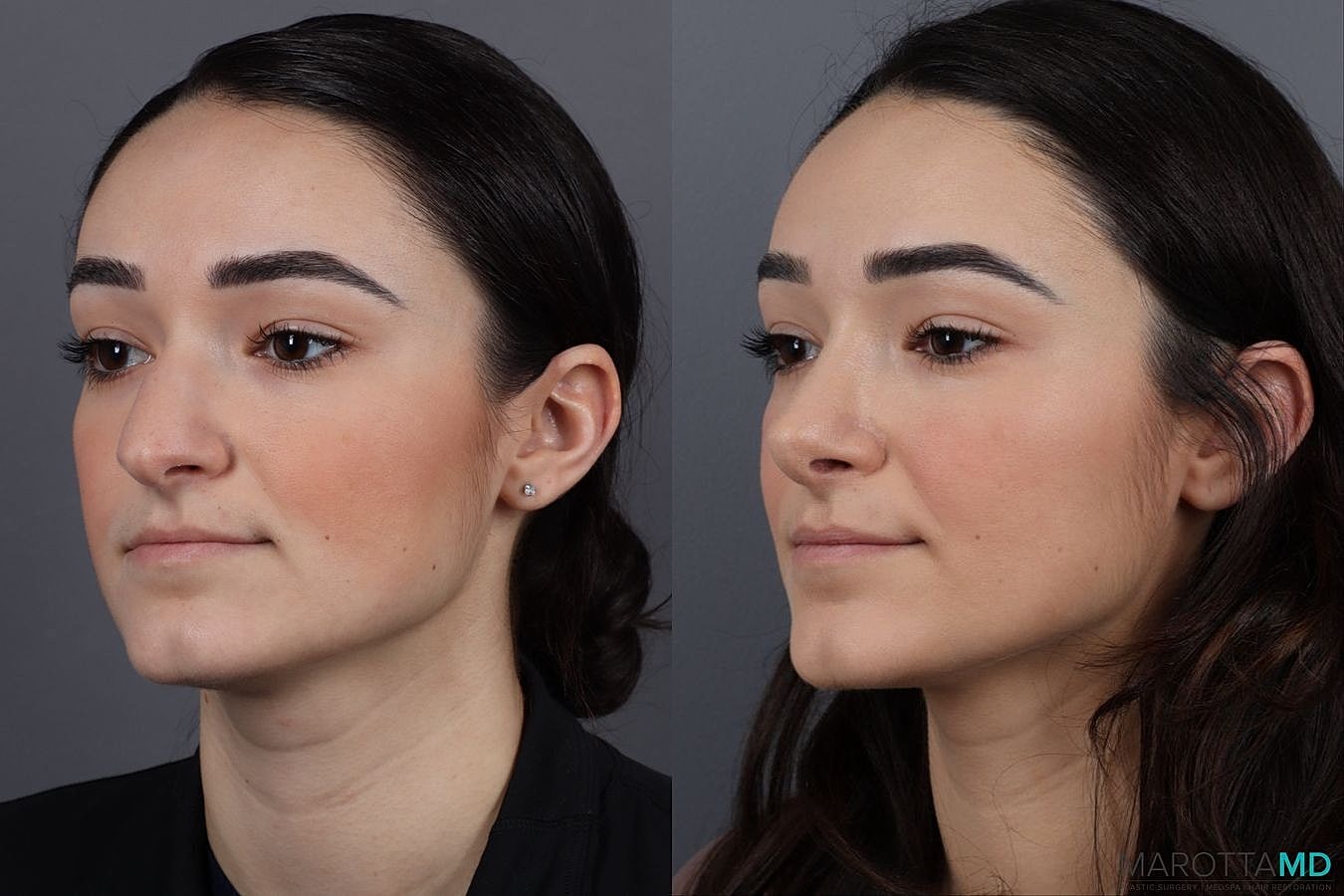 Nose Surgery Before & After