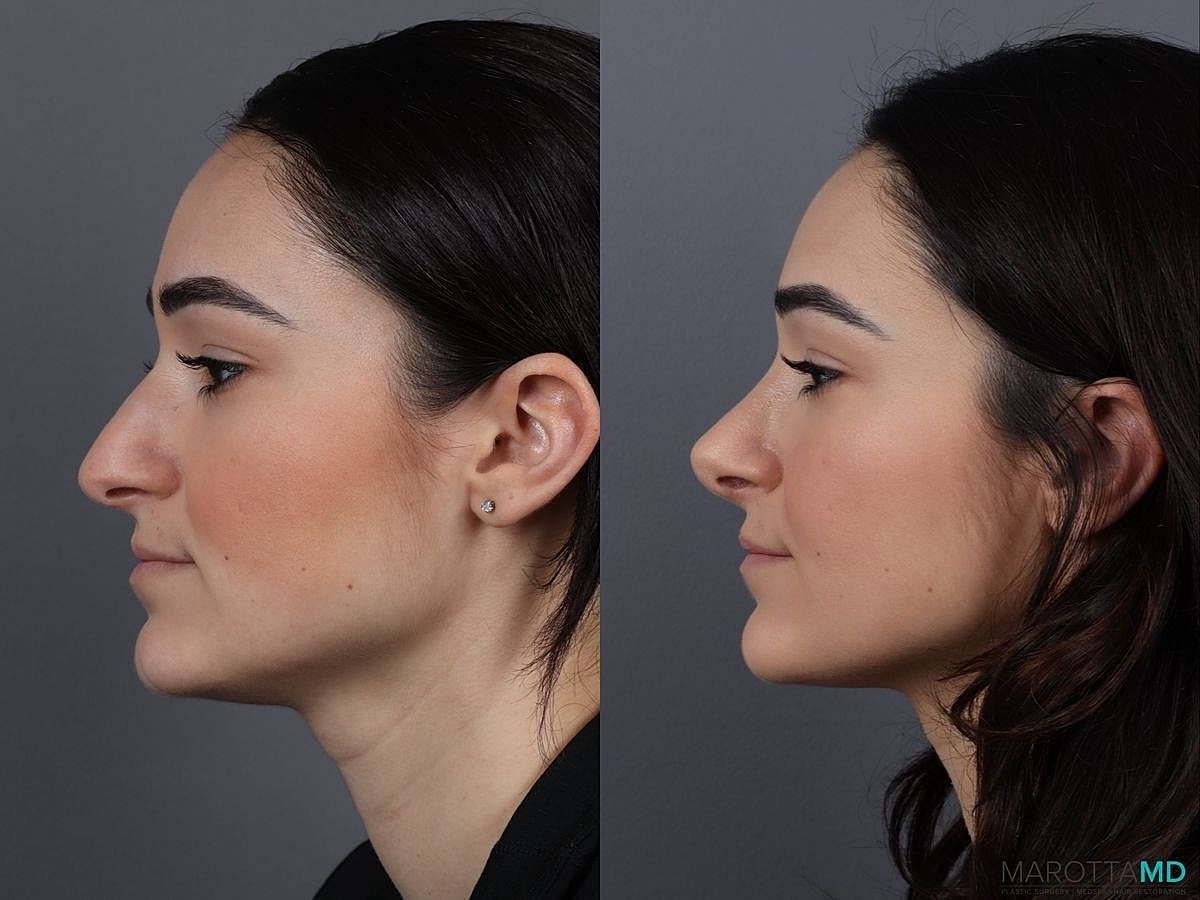 Nose Surgery Before & After