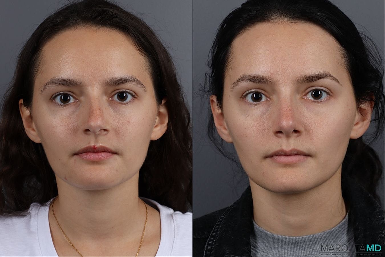 Nose Surgery Before & After