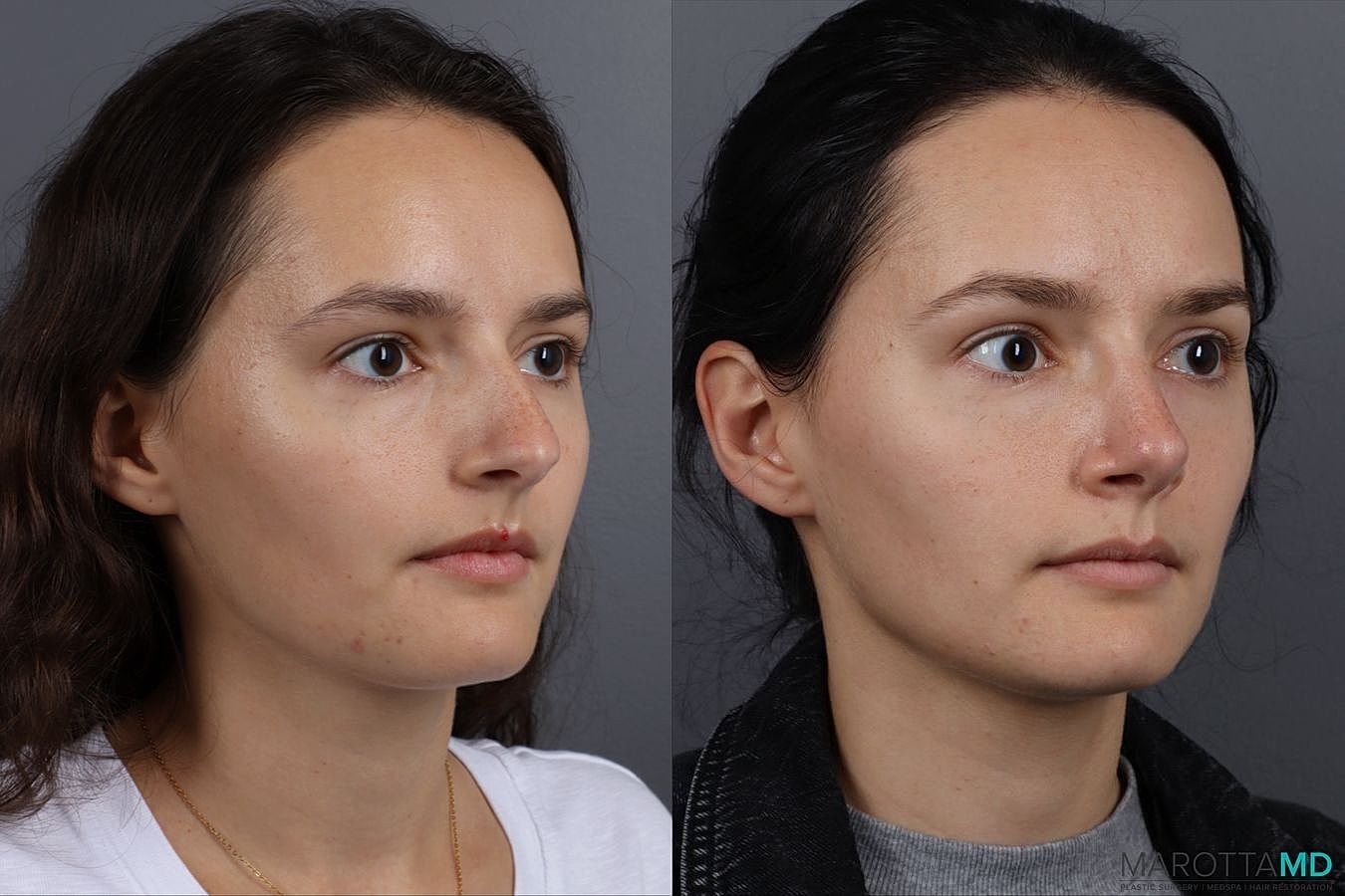 Nose Surgery Before & After