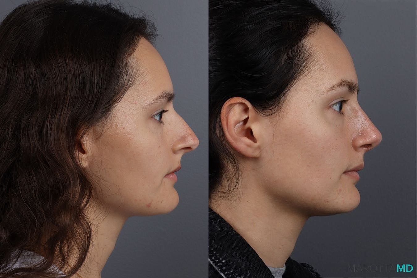 Nose Surgery Before & After