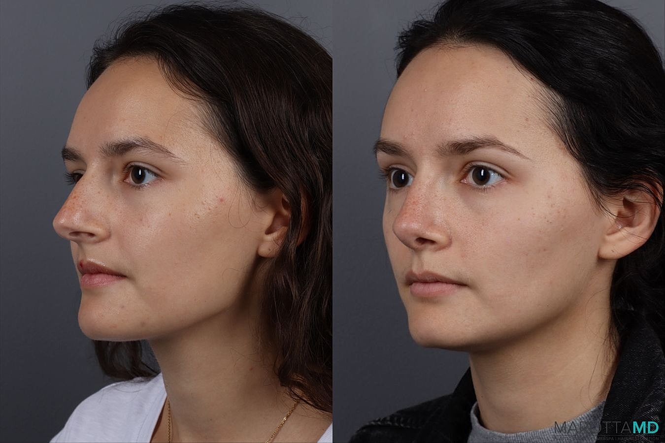Nose Surgery Before & After