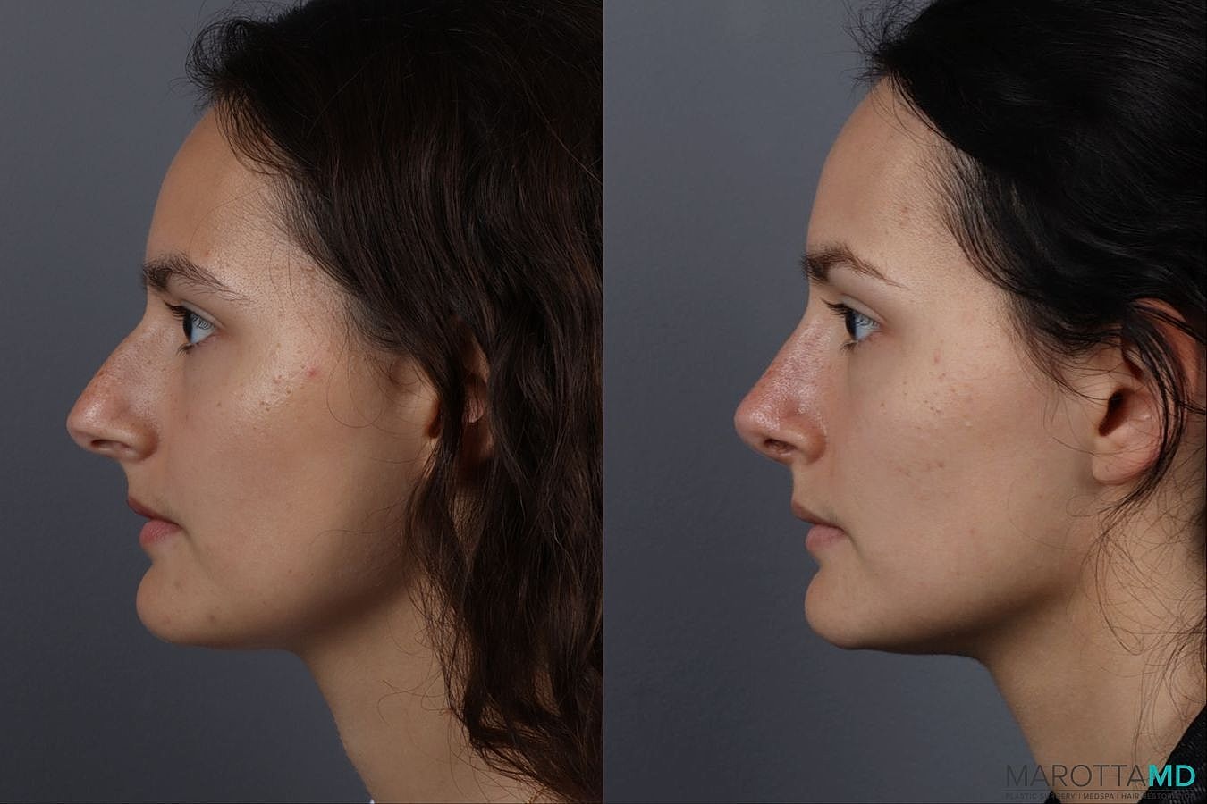 Nose Surgery Before & After