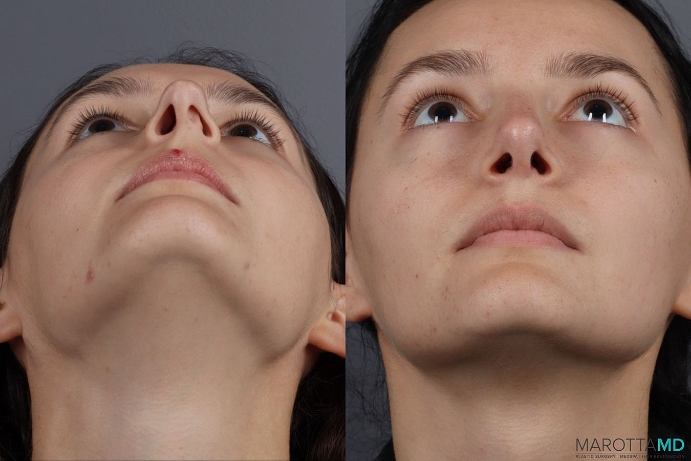 Nose Surgery Before & After
