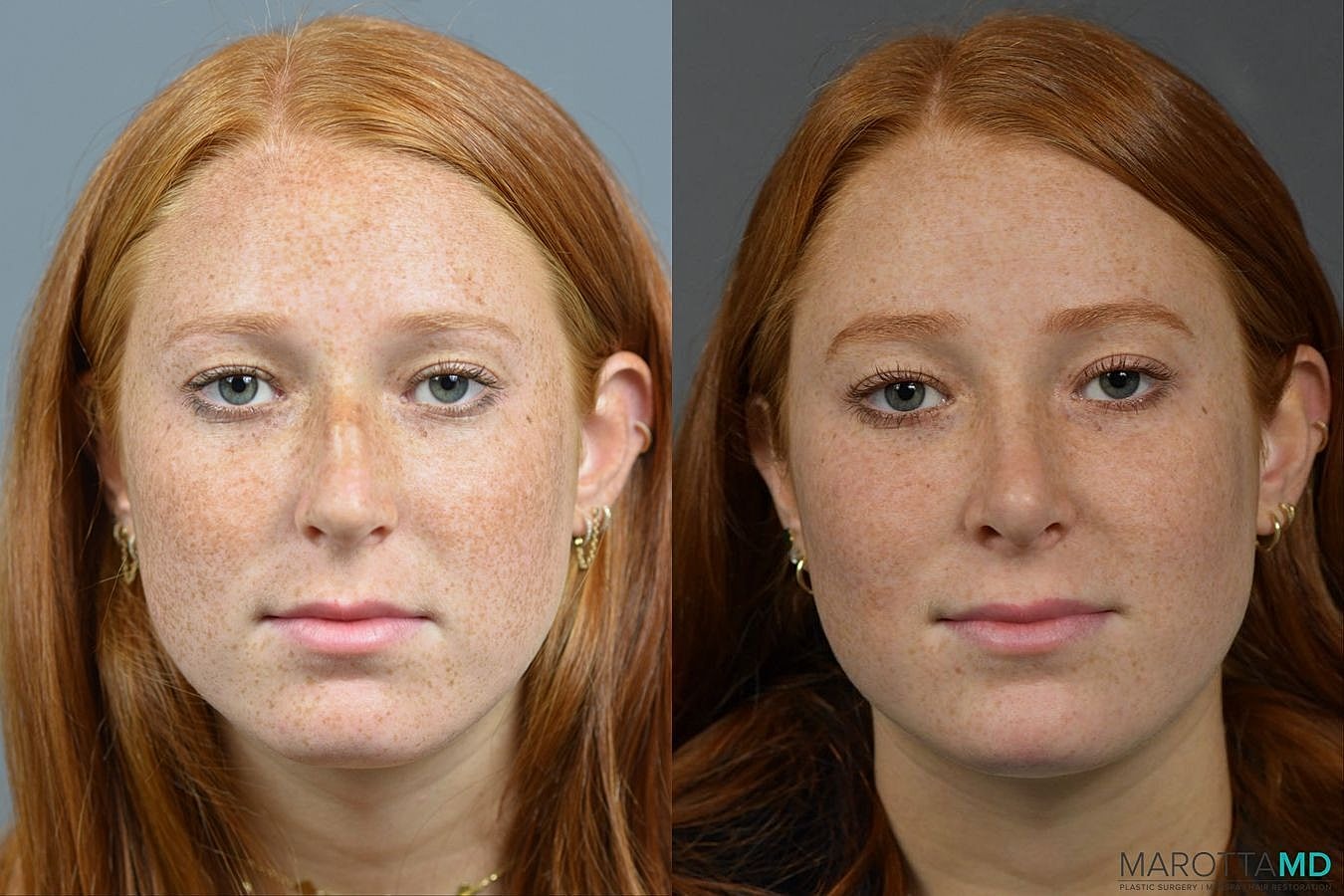Nose Surgery Before & After
