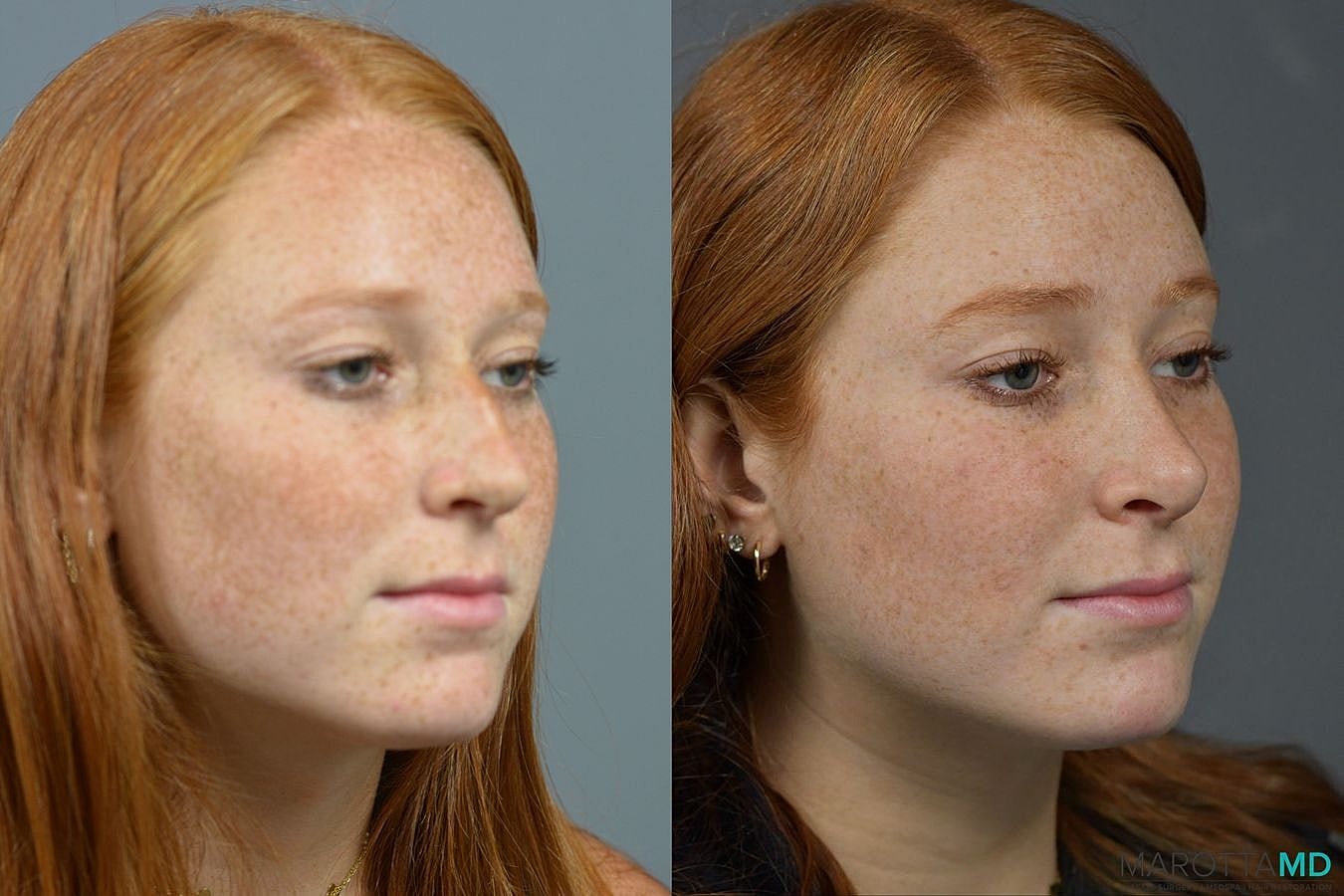 Nose Surgery Before & After