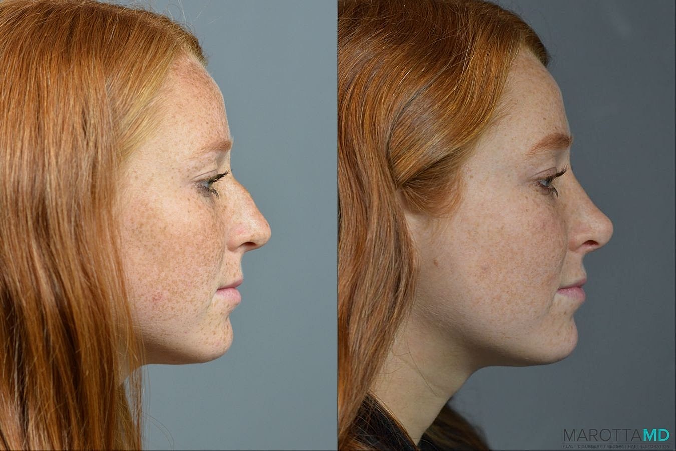 Nose Surgery Before & After
