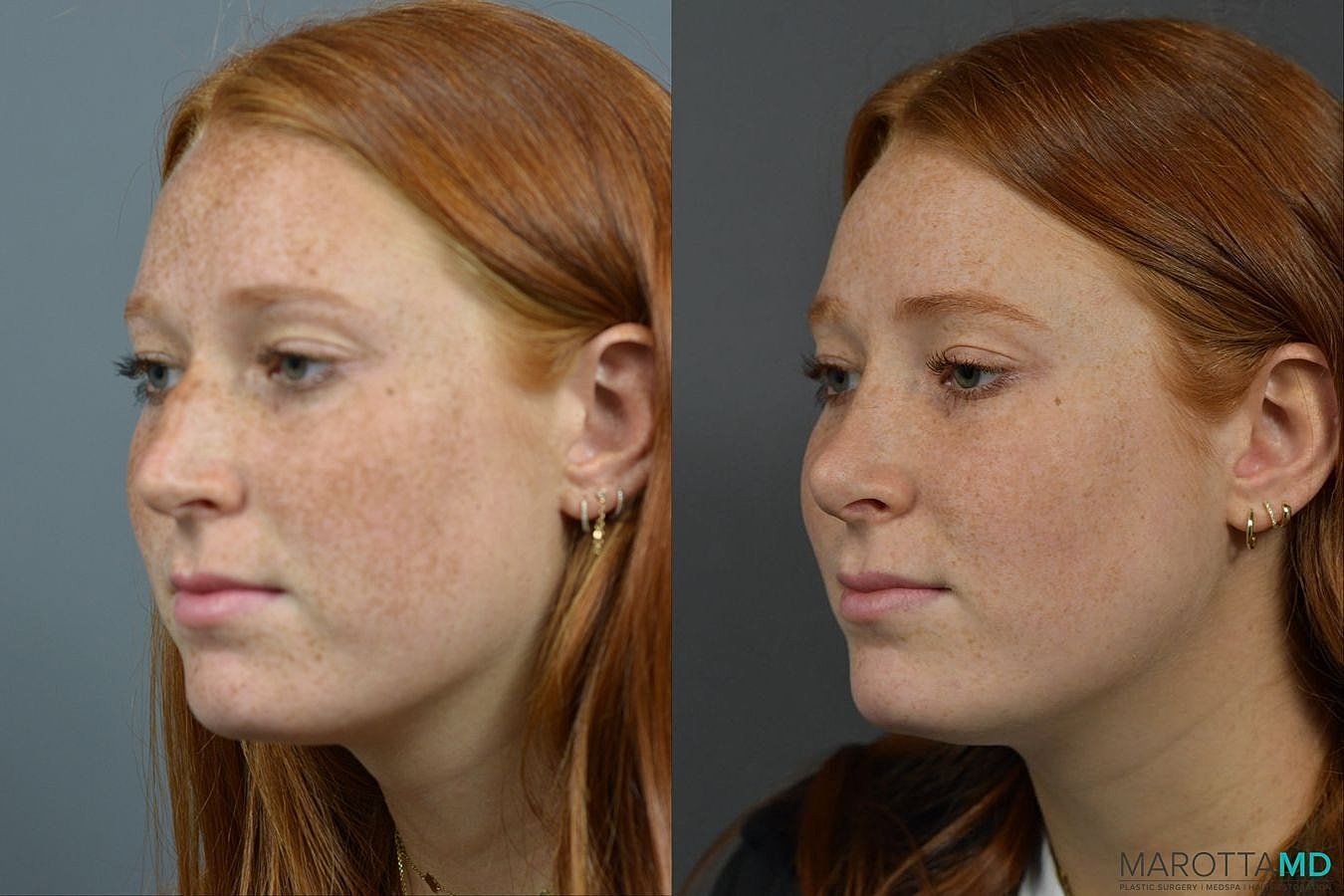Nose Surgery Before & After