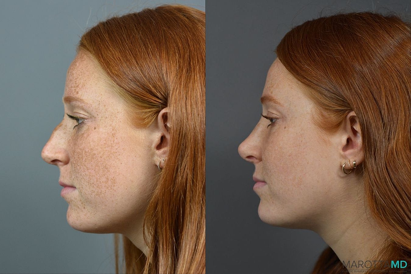 Nose Surgery Before & After