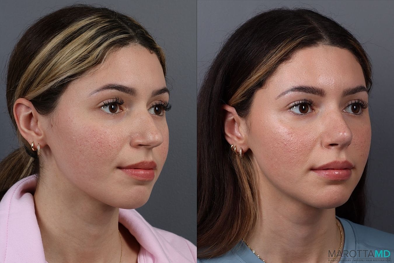 Nose Surgery Before & After