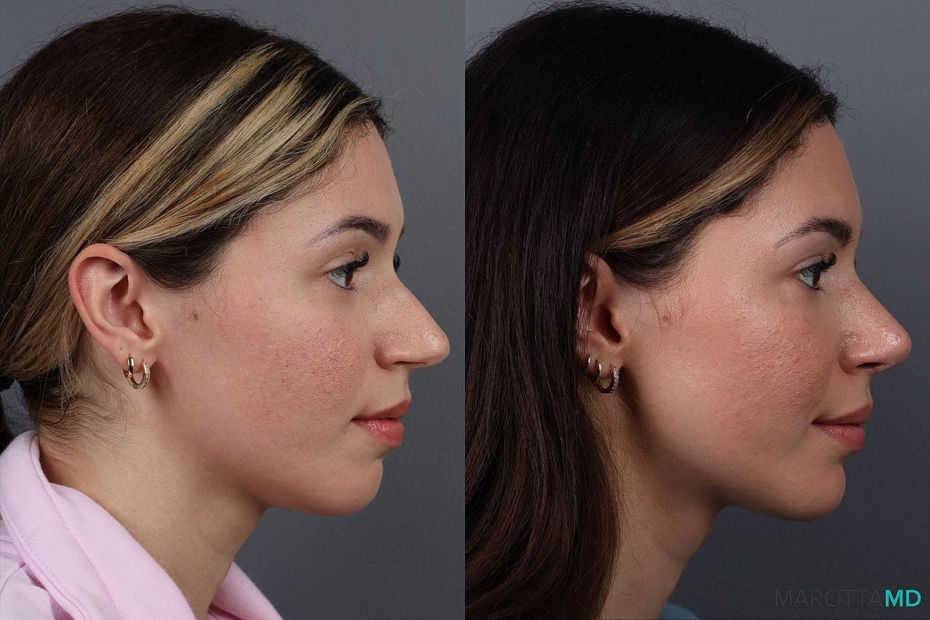 Nose Surgery Before & After