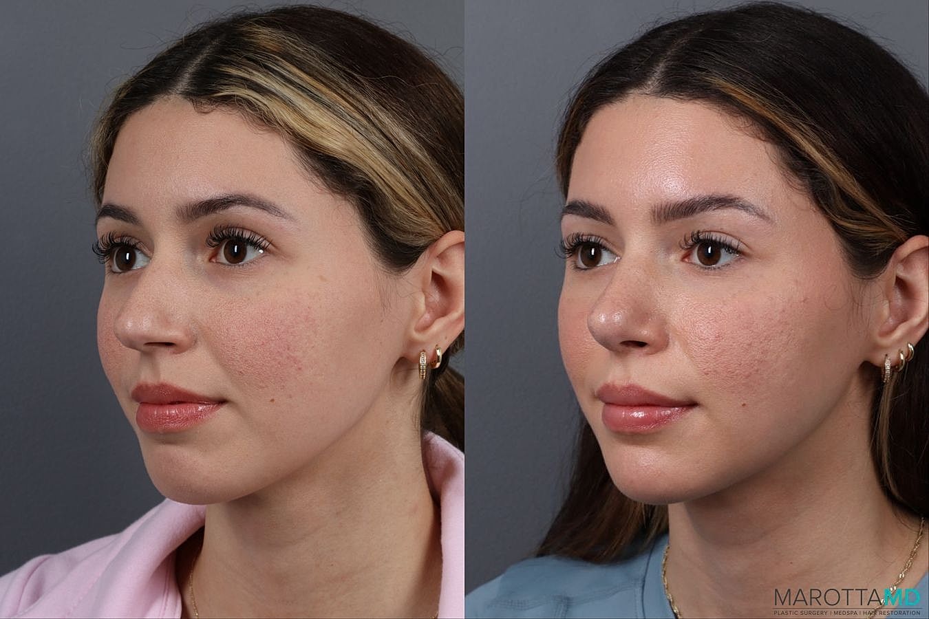 Nose Surgery Before & After