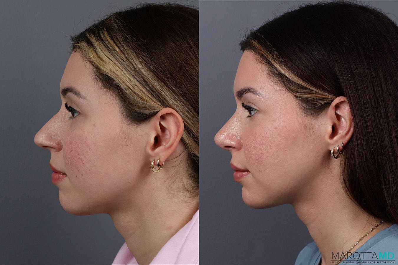 Nose Surgery Before & After