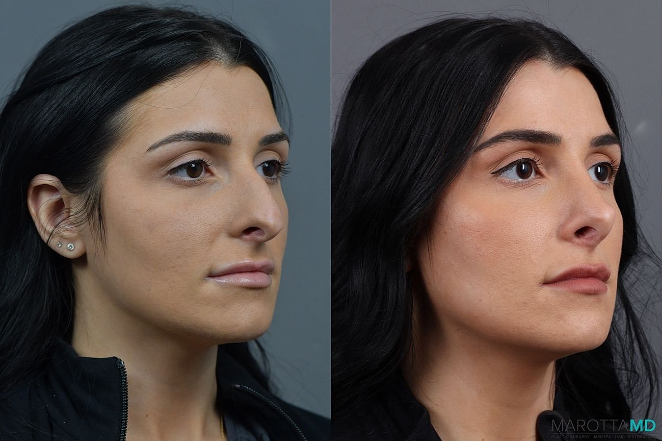 Nose Surgery Before & After
