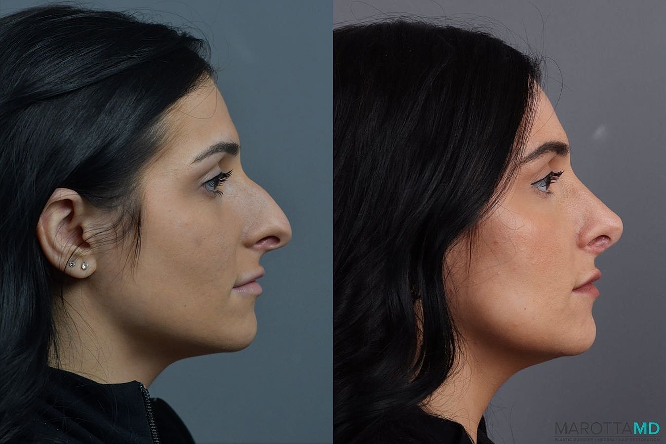 Nose Surgery Before & After