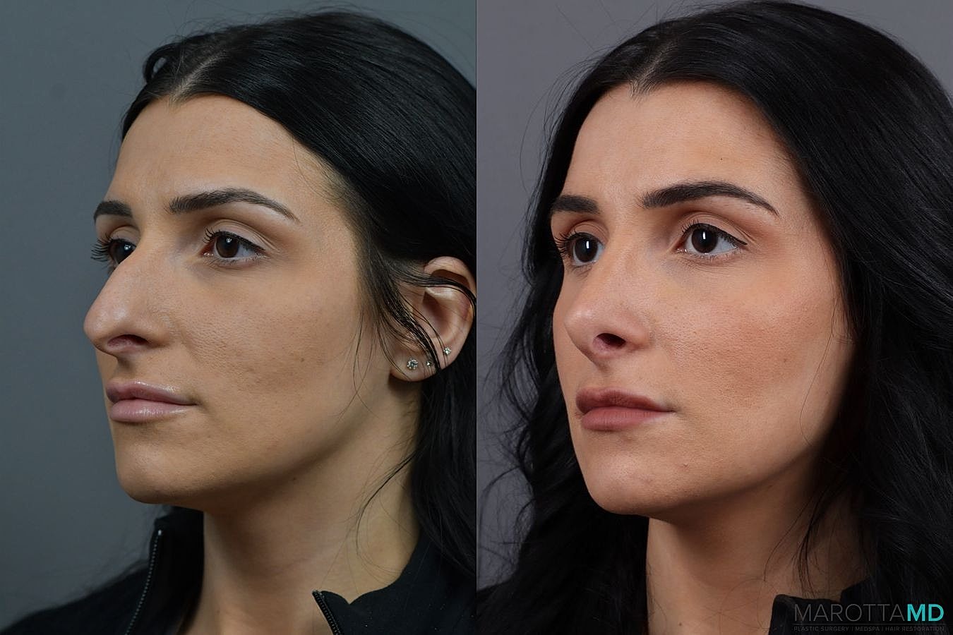 Nose Surgery Before & After