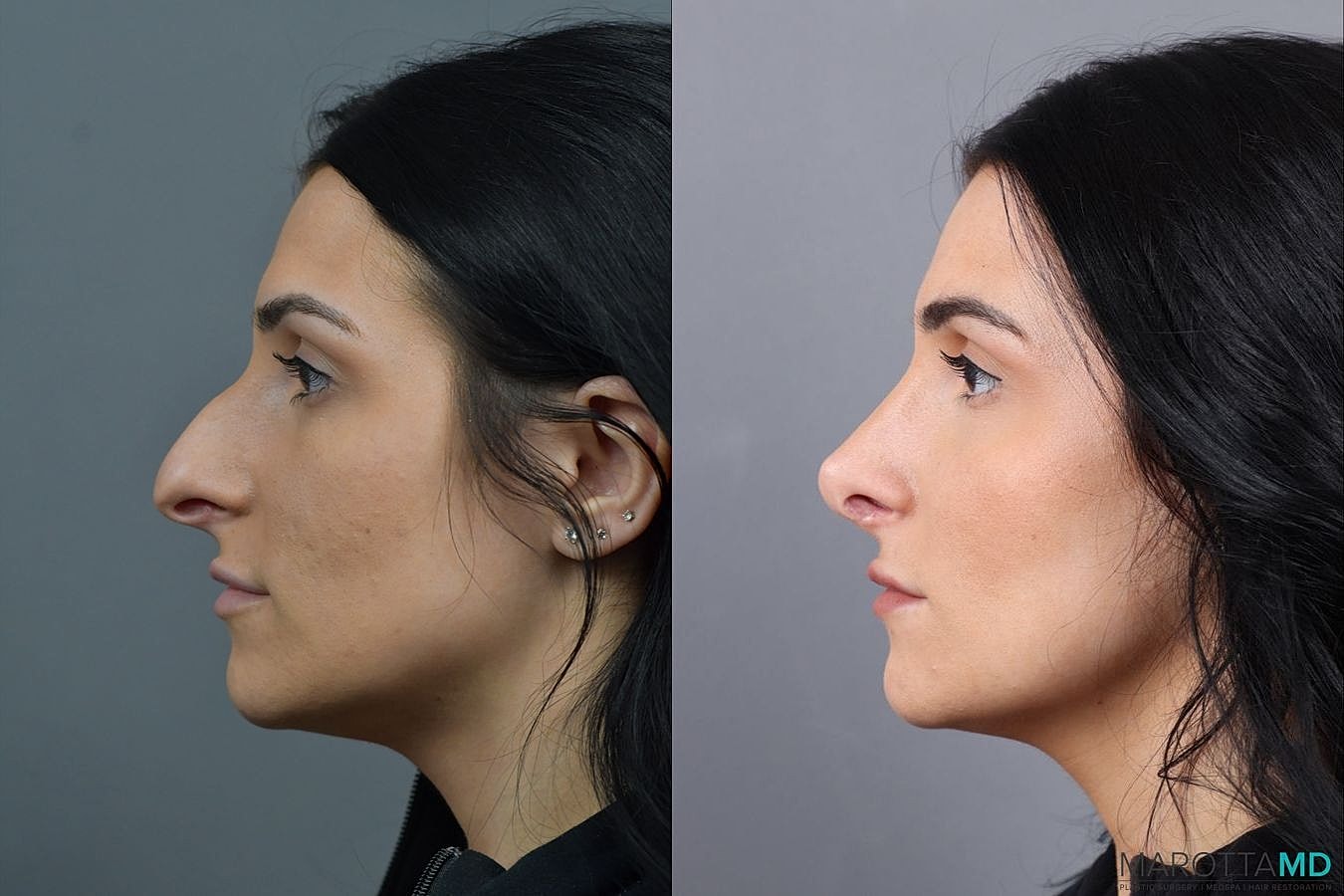 Nose Surgery Before & After