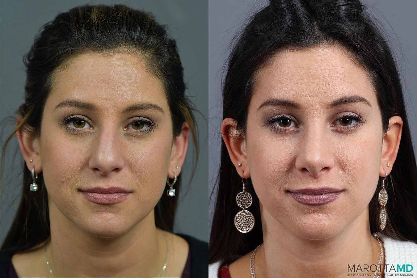Nose Surgery Before & After