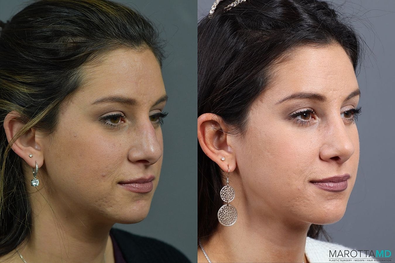 Nose Surgery Before & After
