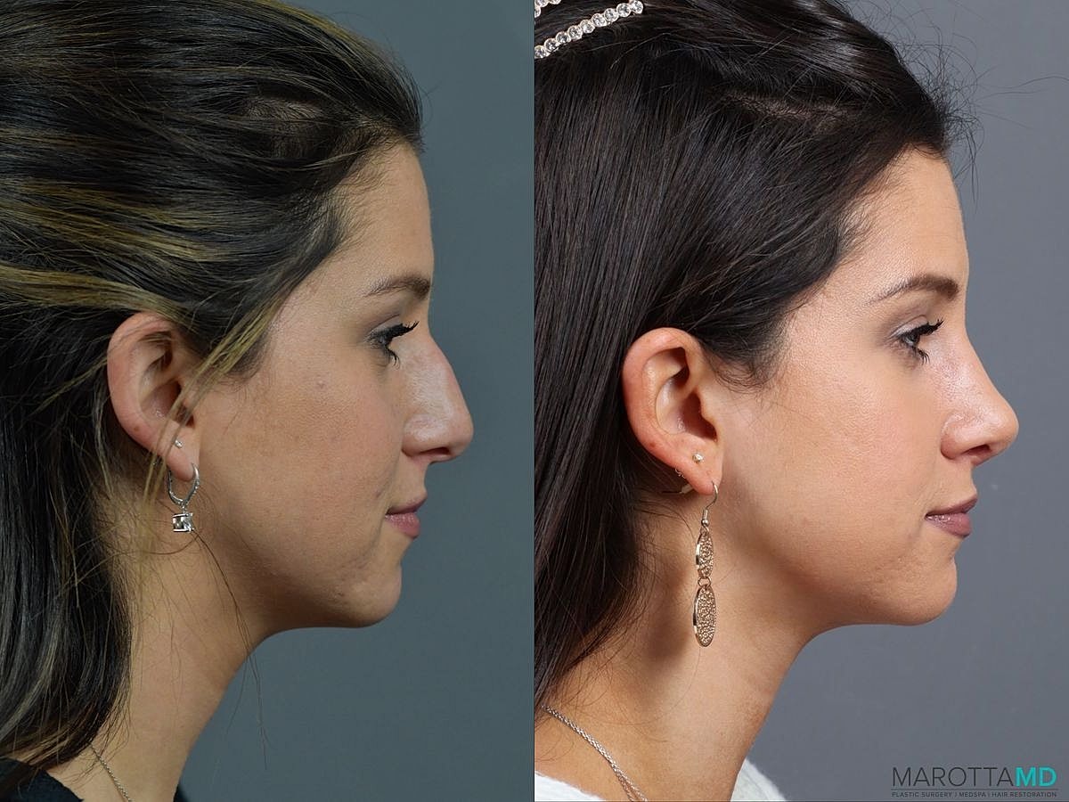Nose Surgery Before & After