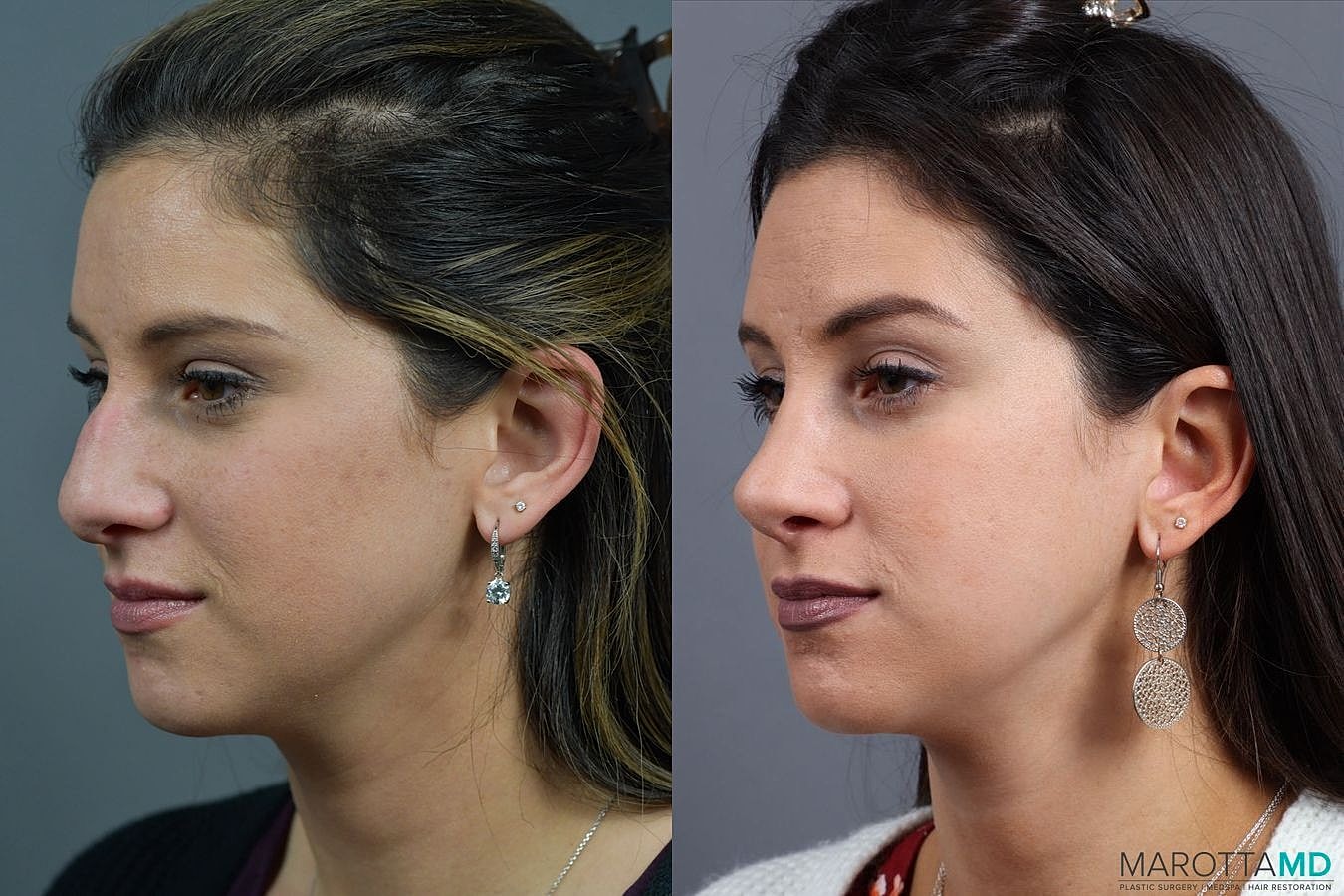 Nose Surgery Before & After