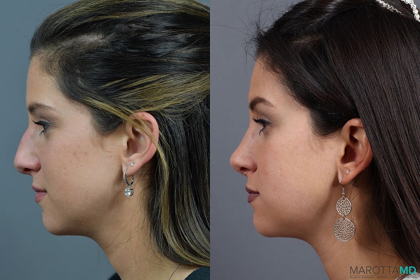 Nose Surgery Before & After